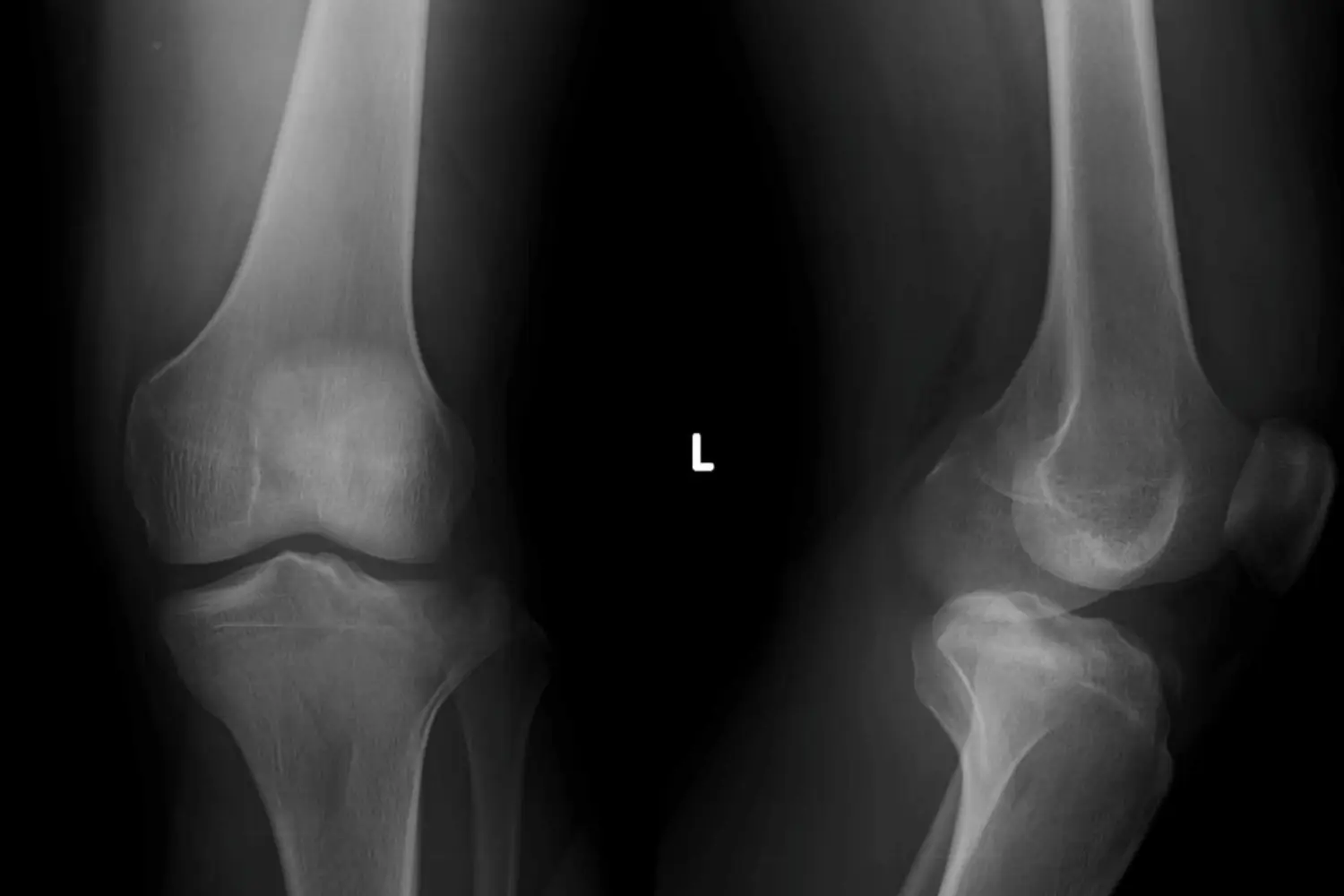 Knee Replacement Surgery in Coimbatore – Advanced Joint Care